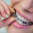 teeth invisalign  cost